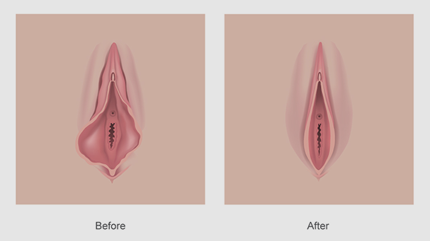 vaginal-tightening-treatment in Bangalore